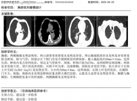 80岁老人抗癌五年 EGFR基因检测到第21外显子存在L861Q突变