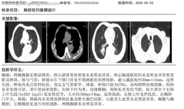 80岁老人抗癌五年 EGFR基因检测到第21外显子存在L861Q突变